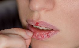 Làm sao để có đôi môi căng mọng? Tại sao uống nước đầy đủ nhưng môi vẫn khô? Cẩn thận bạn đang gặp những vấn đề này...