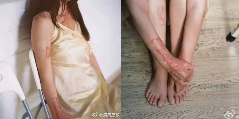 "Ăn không được đạp đổ" ! Kẻ cuồng yêu tạt axit cô gái vì bị từ chối hết 2 lần!