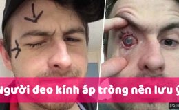 viêm giác mạc Acanthamoeba