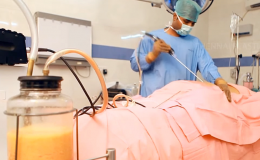 Mổ lấy thai bác sĩ bóc mỡ bụng luôn cho em nhé