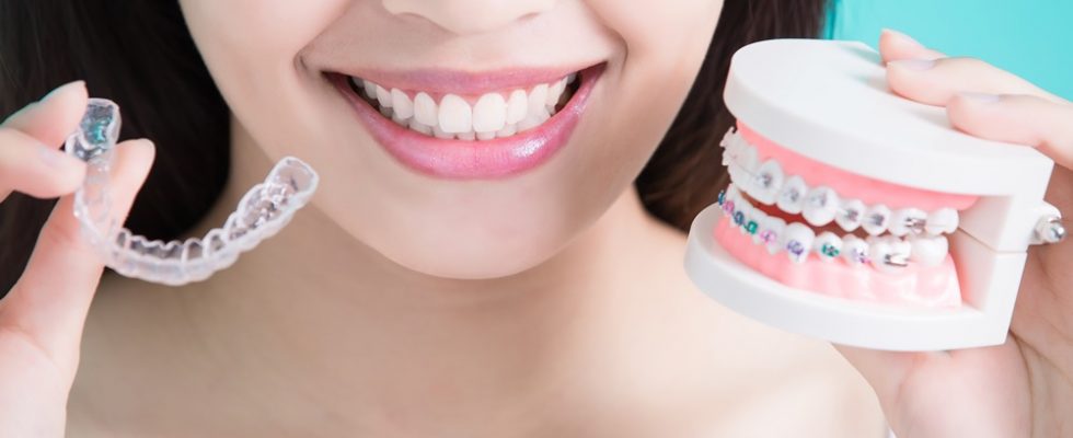 niềng răng uy tín