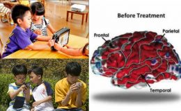 hiện tượng vỏ não bị mỏng sớm