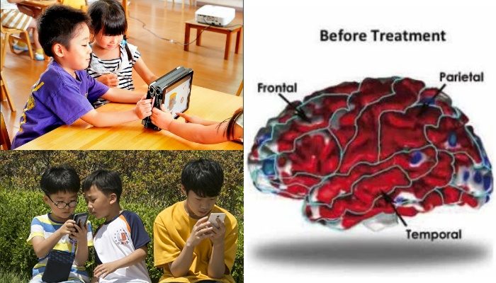 hiện tượng vỏ não bị mỏng sớm