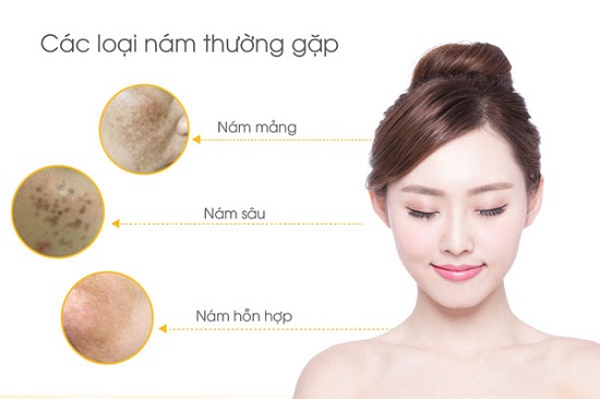 trị nám
