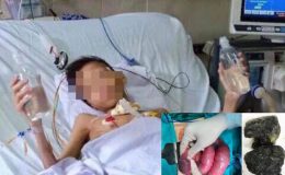 Thanh niên 2 tuổi tắc ruột do khối bã thức ăn