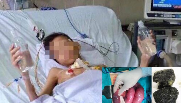 Thanh niên 2 tuổi tắc ruột do khối bã thức ăn