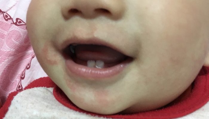 Mẩn đỏ quanh miệng bé