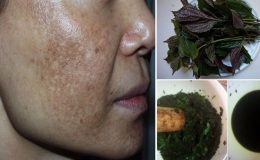 trị nám da tại nhà