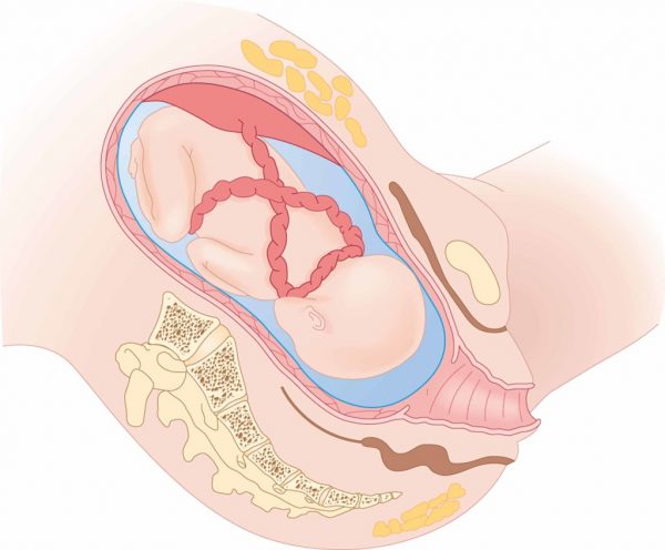 DÂY RỐN CUỐN CỔ