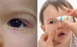 Viêm kết mạc giả mạc - Bệnh hay gặp ở trẻ khi giao mùa và những điều cha mẹ cần biết