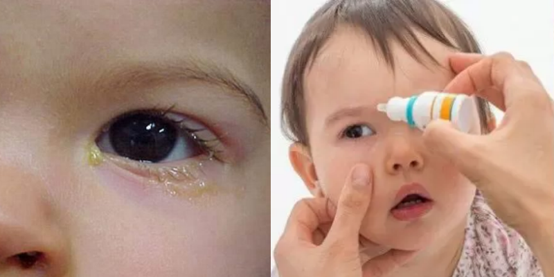 Viêm kết mạc giả mạc - Bệnh hay gặp ở trẻ khi giao mùa và những điều cha mẹ cần biết