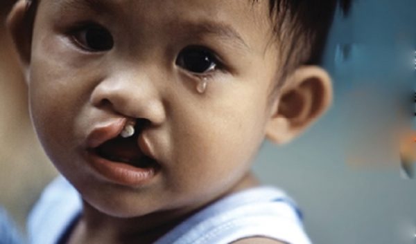 7 tác nhân gây dị tật thai nhi mẹ bầu cần phải biết