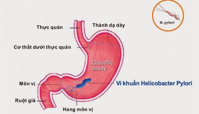 Các xét nghiệm để chẩn đoán vi khuẩn HP dạ dày