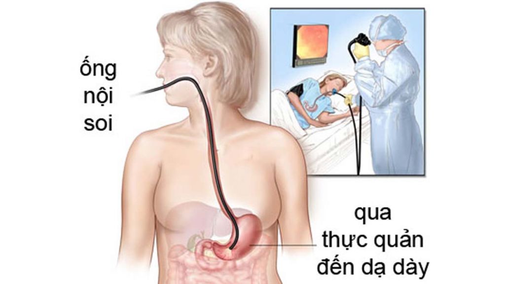 Nội soi dạ dày
