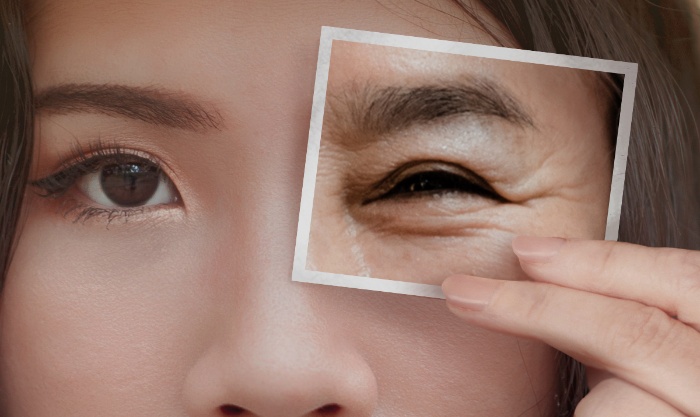 đối phó với nếp nhăn