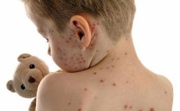 Bệnh thủy đậu ở trẻ: Mẹ cần xử lý thế nào?