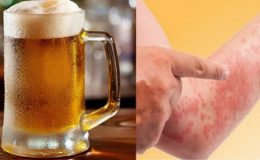 nổi mẩn đỏ khi uống rượu
