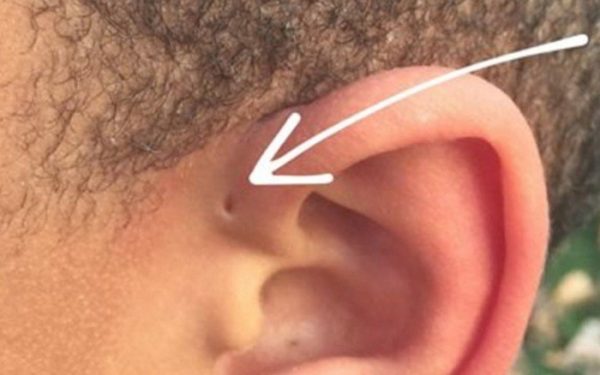 Lỗ nhỏ trên lỗ tai trẻ em là bệnh gì? Bệnh rò luân nhĩ là gì?