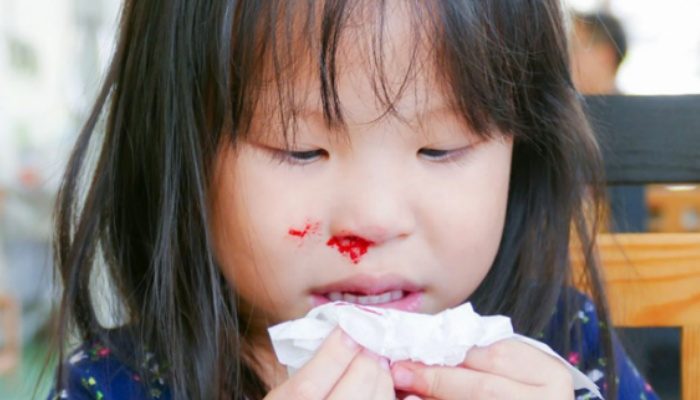chảy máu mũi