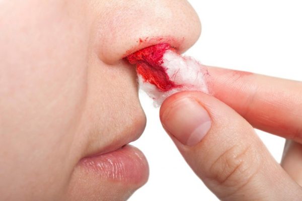 Những sai lầm xử lý khi bạn bị chảy máu mũi