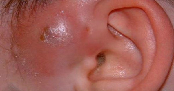 Lỗ nhỏ trên lỗ tai trẻ em là bệnh gì? Bệnh rò luân nhĩ là gì?
