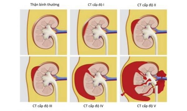 Khi trẻ em bị chấn thương thận