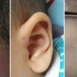 Lỗ nhỏ trên lỗ tai trẻ em là bệnh gì? Nếu bốc mùi thì có sao không?