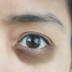 Nghiện chơi điện thoại thường xuyên gây bọng mắt nặng! 3 cách giúp cải thiện bọng mắt hiệu quả