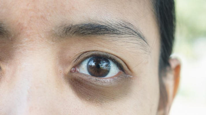 Nghiện chơi điện thoại thường xuyên gây bọng mắt nặng! 3 cách giúp cải thiện bọng mắt hiệu quả
