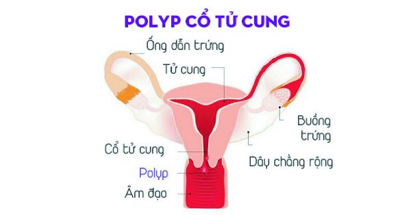 Bệnh Polyp cổ tử cung và những điều chị em phụ nữ không nên bỏ qua