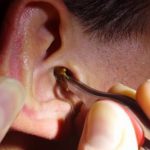 Mẹo xử lý khi côn trùng chui vào tai