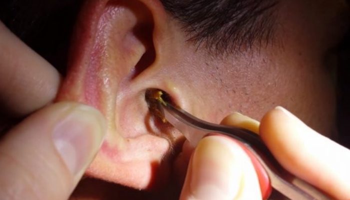 Mẹo xử lý khi côn trùng chui vào tai