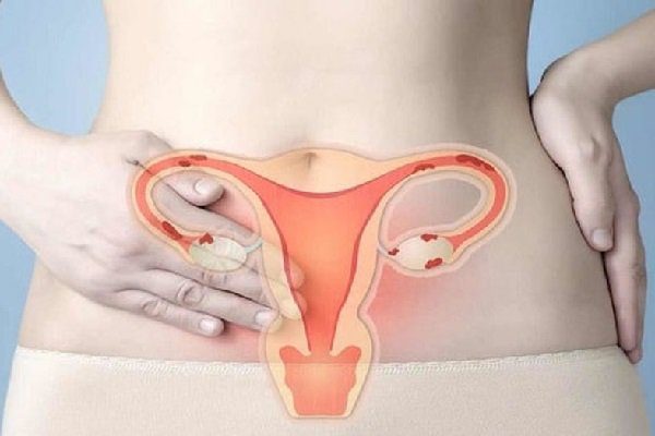Dấu hiệu bạn đang mắc bệnh viêm cổ tử cung và cách thức phòng ngừa
