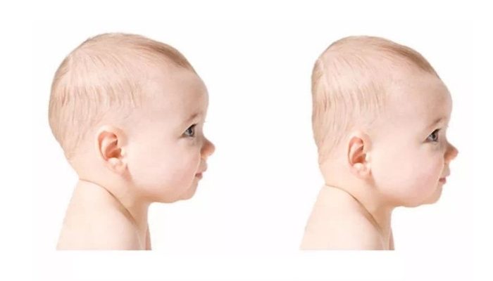 Hội chứng bẹt đầu ở trẻ sơ sinh! Bố mẹ cần lưu ý điều gì?
