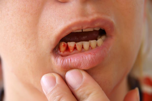 Thói quen xỉa răng bằng tăm tưởng bình thường hoá ra lại ẩn chứa rất nhiều tác hại!