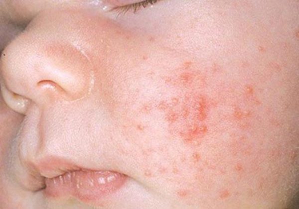 Mụn bất thường ở trẻ sơ sinh và cách chăm sóc mẹ cần lưu ý