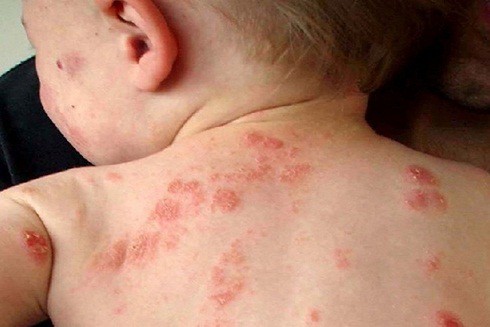 Mụn bất thường ở trẻ sơ sinh và cách chăm sóc mẹ cần lưu ý