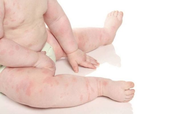 Mụn bất thường ở trẻ sơ sinh và cách chăm sóc mẹ cần lưu ý