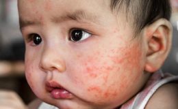 Mụn bất thường ở trẻ sơ sinh và cách chăm sóc mẹ cần lưu ý
