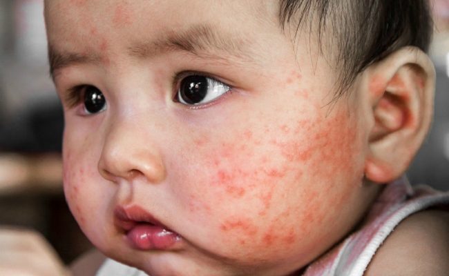 Mụn bất thường ở trẻ sơ sinh và cách chăm sóc mẹ cần lưu ý