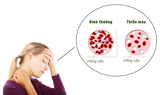 Thi thoảng thấy hoa mắt chóng mặt là bị làm sao? Thiếu máu và cách giảm nguy cơ thiếu máu để cải thiện sức khỏe