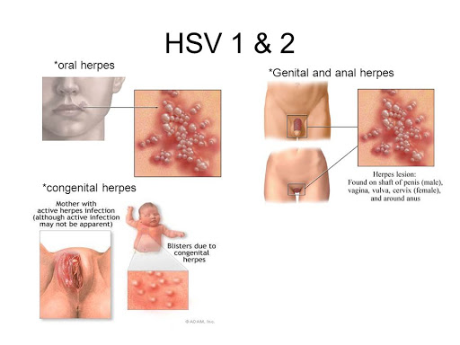 Mẹ bầu nhiễm mụn rộp sinh dục do Virus Herpes có nguy hiểm thế nào đến thai nhi?